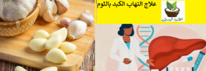 علاج التهاب الكبد بالثوم
