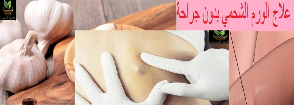 علاج الورم الشحمي بدون جراحة