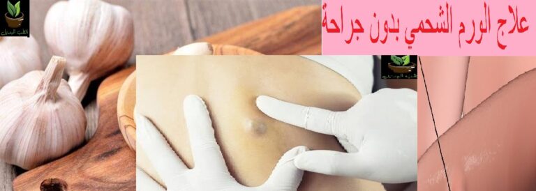 علاج الورم الشحمي بدون جراحة