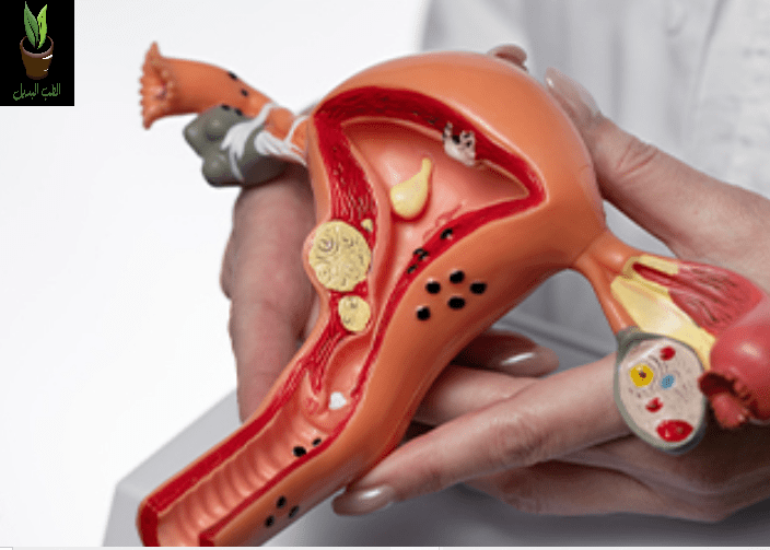 كيف أعالج التهابات عنق الرحم  الشديد بالأعشاب في البيت  ؟