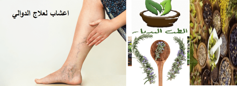 اعشاب لعلاج الدوالي