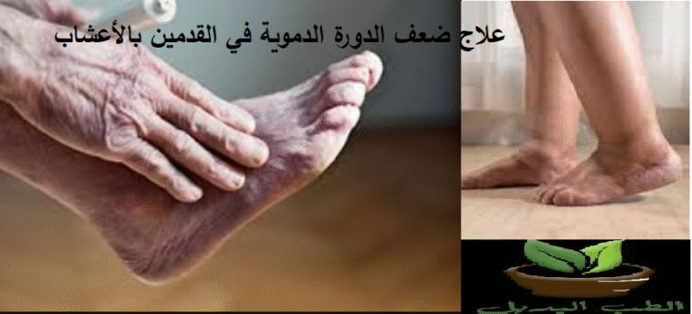 علاج ضعف الدورة الدموية في القدمين بالأعشاب